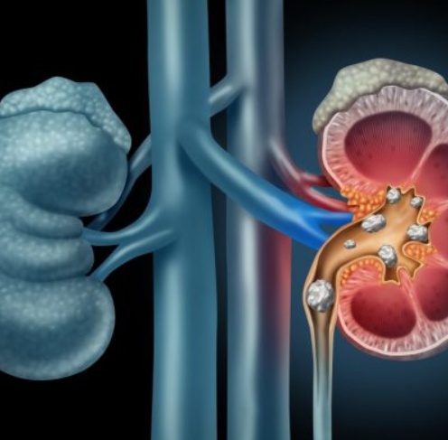 Kidney Stone Diagram